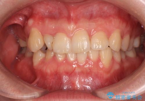 捻転の強い前歯 ワイヤー装置での非抜歯矯正の症例 治療前