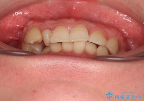 捻転の強い前歯 ワイヤー装置での非抜歯矯正の治療前