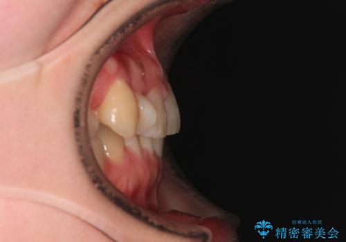 捻転の強い前歯 ワイヤー装置での非抜歯矯正の治療前