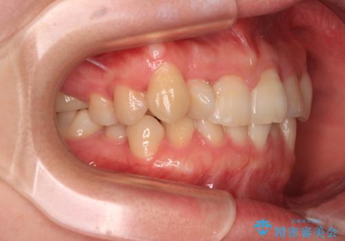 捻転の強い前歯 ワイヤー装置での非抜歯矯正の治療前