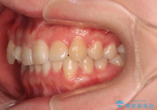 捻転の強い前歯 ワイヤー装置での非抜歯矯正の治療前