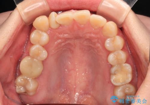 捻転の強い前歯 ワイヤー装置での非抜歯矯正の治療前