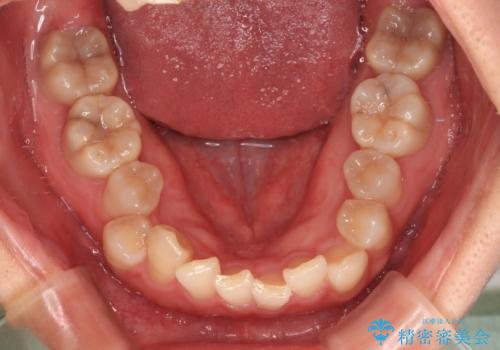 捻転の強い前歯 ワイヤー装置での非抜歯矯正の治療前