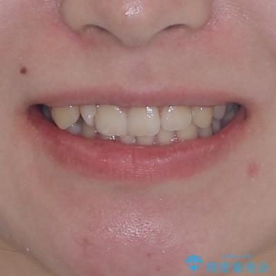 捻転の強い前歯 ワイヤー装置での非抜歯矯正の治療前(顔貌)