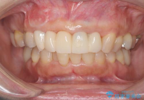歯茎の腫れが気になる方必見!|抜歯即時インプラントで前歯5本を痛みなく3か月で治療完了!の治療中
