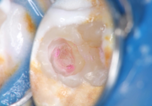 虫歯治療後、精度の良いゴールドアンレーへの治療中