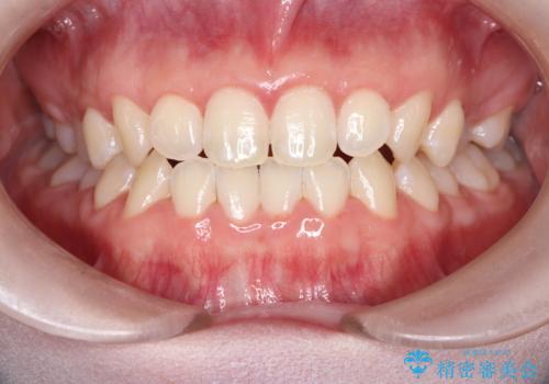 初めてのホワイトニングの治療前