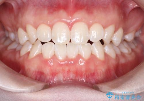 初めてのホワイトニング