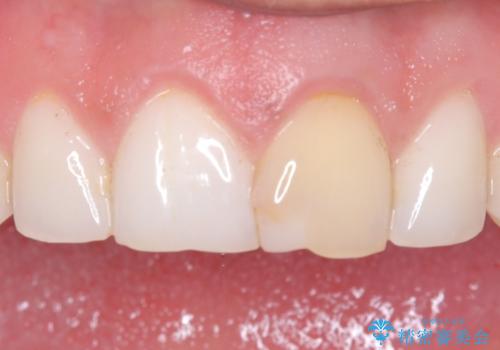 前歯の変色が気になる〈セラミッククラウン〉の症例 治療前