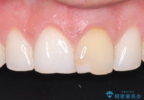 前歯の変色が気になる〈セラミッククラウン〉の治療前