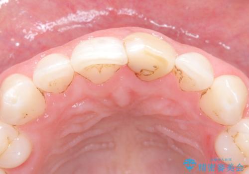 前歯の変色が気になる〈セラミッククラウン〉の治療前
