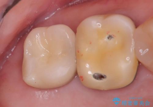 根尖性歯周炎|歯根嚢胞|インプラント治療の治療後