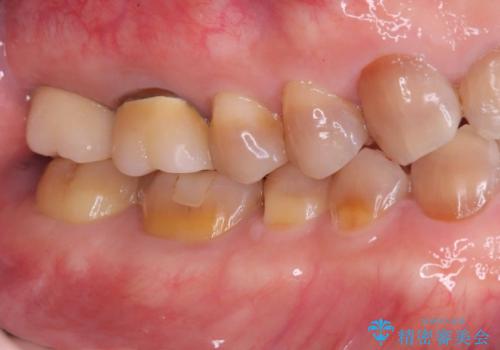 根尖性歯周炎|歯根嚢胞|インプラント治療の治療後