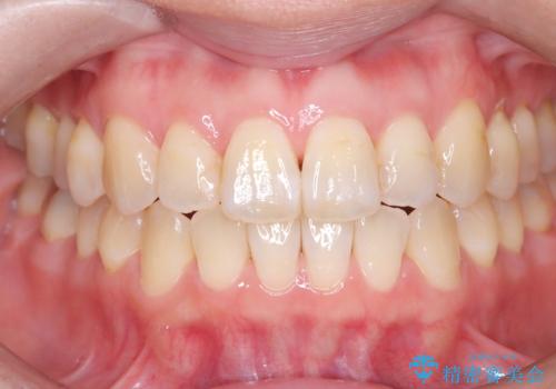 エアーフロー&オフィスホワイトニングの治療前