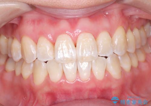 エアーフロー&オフィスホワイトニングの治療後