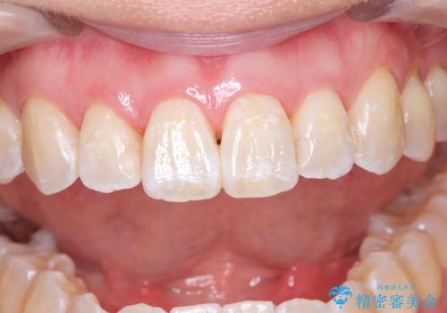 エアーフロー&オフィスホワイトニング