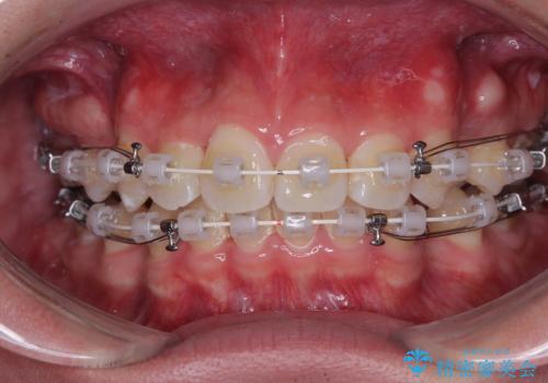 前歯のデコボコと正中のずれを改善!白い装置で目立たない矯正の治療中