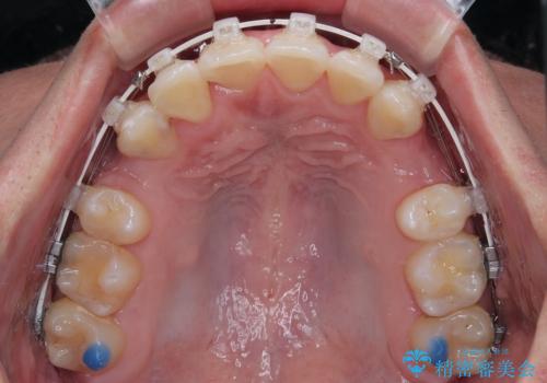 前歯のデコボコと正中のずれを改善!白い装置で目立たない矯正の治療中