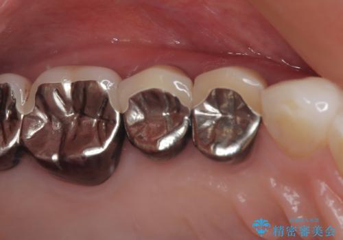 変色を綺麗にしたい 前歯と奥歯のオールセラミッククラウン治療の治療前