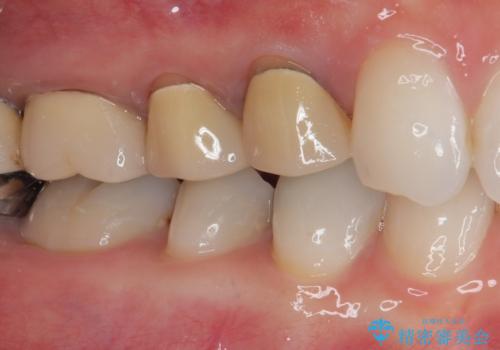 変色を綺麗にしたい 前歯と奥歯のオールセラミッククラウン治療の治療前