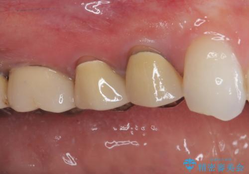 変色を綺麗にしたい 前歯と奥歯のオールセラミッククラウン治療の治療前