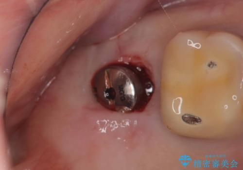 根尖性歯周炎|歯根嚢胞|インプラント治療の治療中