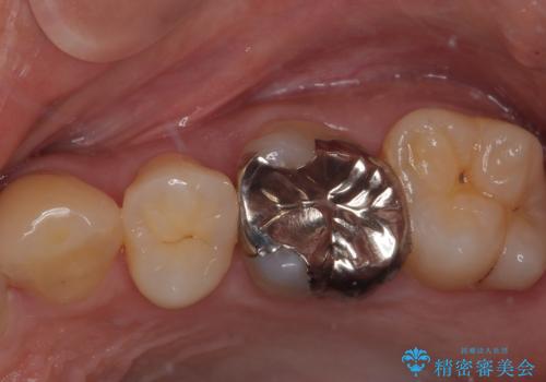 銀歯を外したい オールセラミッククラウンの症例 治療前