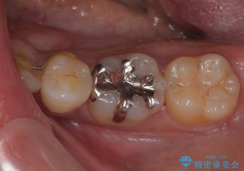 セラミックに取り替えたい　セラミックインレー修復の症例 治療前