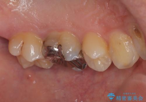銀歯を外したい オールセラミッククラウンの治療前