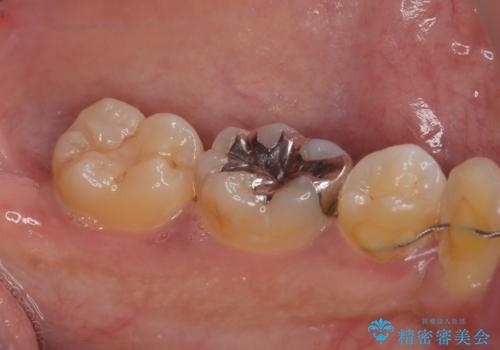 セラミックに取り替えたい　セラミックインレー修復の治療前