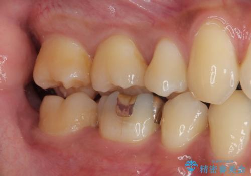 銀歯をセラミックにしたい オールセラミッククラウンの治療前