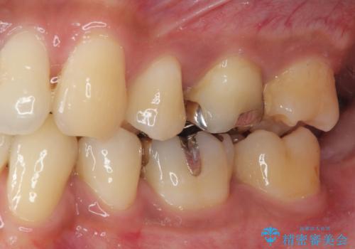 銀歯を外したい オールセラミッククラウンの治療前