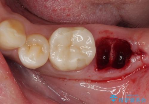 抜歯即時インプラントで治療期間を大幅短縮!抜歯からセラミックまでを3か月で完了の治療前