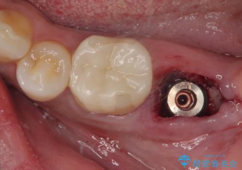 抜歯即時インプラントで治療期間を大幅短縮!抜歯からセラミックまでを3か月で完了の治療中