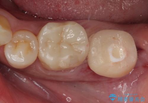 抜歯即時インプラントで治療期間を大幅短縮!抜歯からセラミックまでを3か月で完了の治療後
