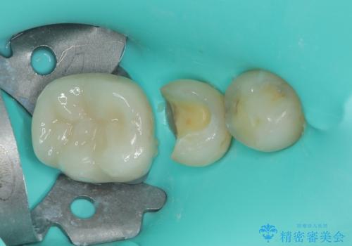 銀歯の下の虫歯を治したい オールセラミッククラウン・セラミックインレー修復の治療中