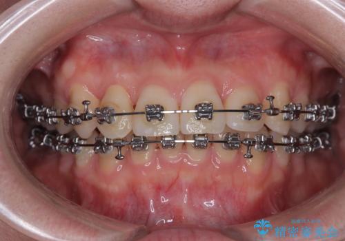 捻転の強い前歯 ワイヤー装置での非抜歯矯正の治療中