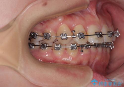 捻転の強い前歯 ワイヤー装置での非抜歯矯正の治療中