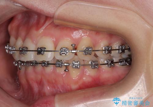 捻転の強い前歯 ワイヤー装置での非抜歯矯正の治療中