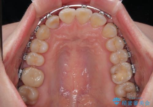 捻転の強い前歯 ワイヤー装置での非抜歯矯正の治療中