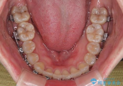 捻転の強い前歯 ワイヤー装置での非抜歯矯正の治療中