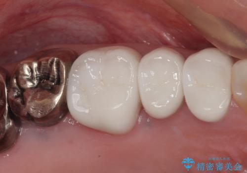 米粒のような小さい歯 セラミッククラウンでバランスを改善の症例 治療後