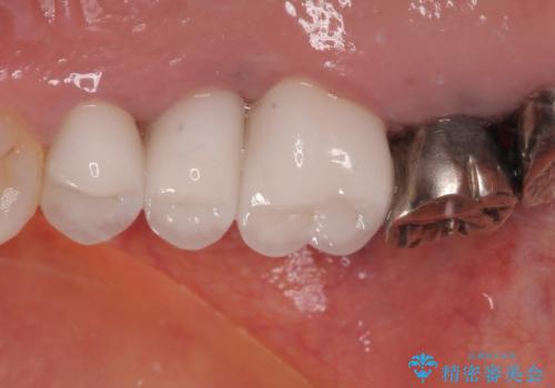 米粒のような小さい歯 セラミッククラウンでバランスを改善の治療後