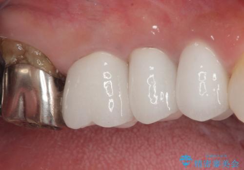 米粒のような小さい歯 セラミッククラウンでバランスを改善の治療後