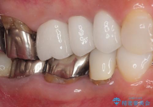 米粒のような小さい歯 セラミッククラウンでバランスを改善の治療後