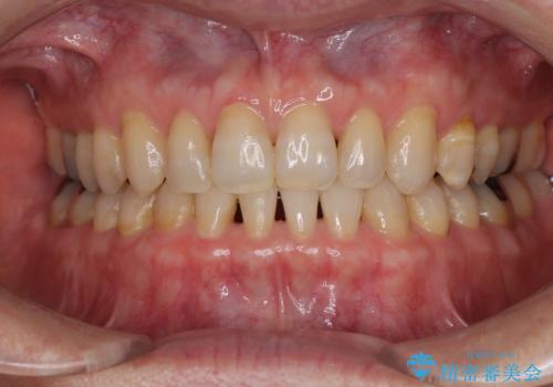 【モニター】ディープバイトで隙間の空いた歯列 ワイヤー装置での非抜歯矯正の症例 治療後