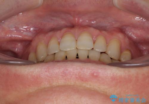 【モニター】ディープバイトで隙間の空いた歯列 ワイヤー装置での非抜歯矯正の治療後