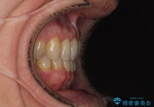 【モニター】ディープバイトで隙間の空いた歯列 ワイヤー装置での非抜歯矯正の治療後