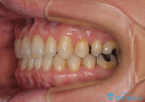 【モニター】ディープバイトで隙間の空いた歯列 ワイヤー装置での非抜歯矯正の治療後
