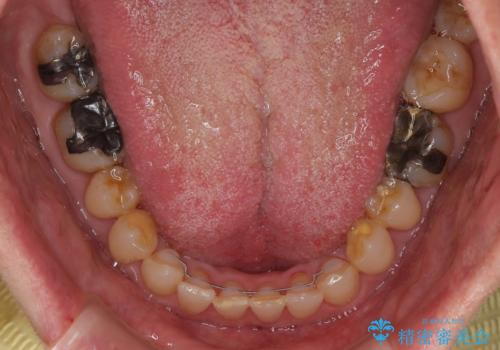 【モニター】ディープバイトで隙間の空いた歯列 ワイヤー装置での非抜歯矯正の治療後